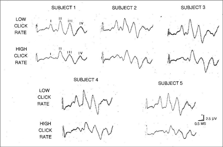 Five examples of the effects of low ( about 10/sec ) and high ( about 100/sec ) stimulus rates on the rat BAEP. Note that at a high click rate, wave I is markedly and invariably attenuated and sometimes difficult to identify at all. In contrast, the later waves ( II, III, and IV ) are all clearly present with little or no evidence of any cumulative impact on either latency or amplitude.